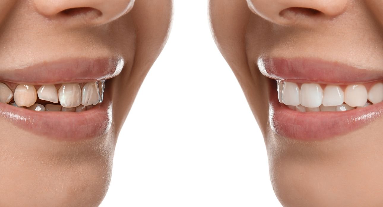 braces-vs-composite-veneers-for-smile-gaps-choose-the-correct-answer