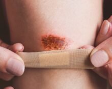 non-suicidal-self-injury-nssi-as-a-coping-mechanism