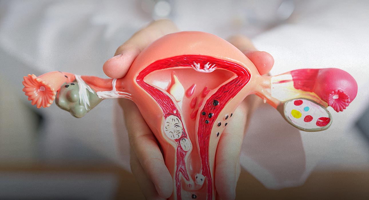 pcos-renamed-as-pmos-in-major-global-shift-in-womens-health-terminology