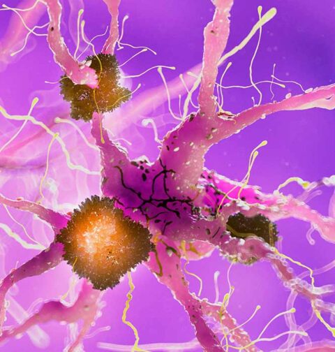 alzheimers-combination-therapy-targeting-amyloid-and-tau-proteins