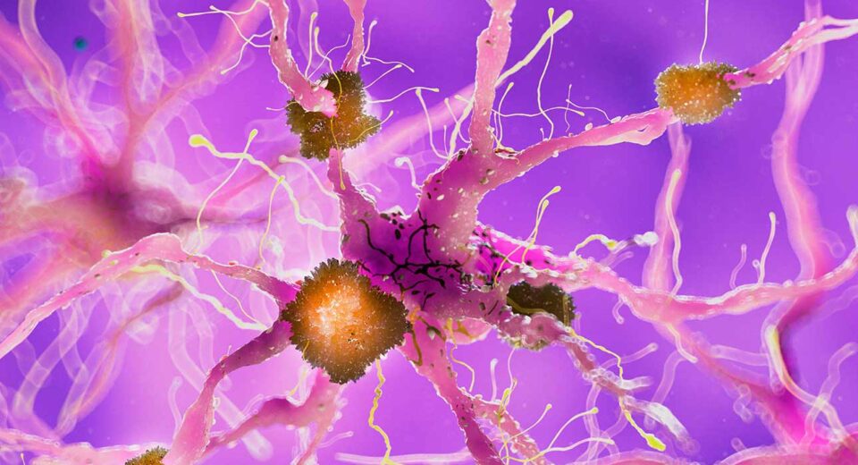 alzheimers-combination-therapy-targeting-amyloid-and-tau-proteins