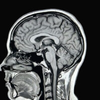 hetairos-ai-predicts-brain-tumour-molecular-subtypes-in-12-minutes
