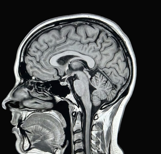 hetairos-ai-predicts-brain-tumour-molecular-subtypes-in-12-minutes